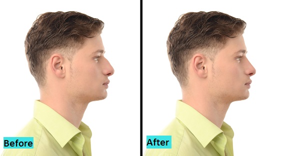 best-rhinoplasty-surgery-treatment-in-pune-india